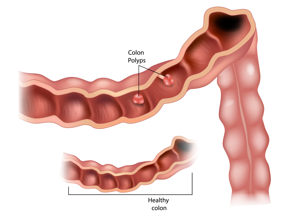 colon-polyps