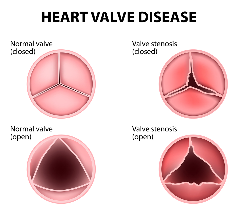 Heart Valves