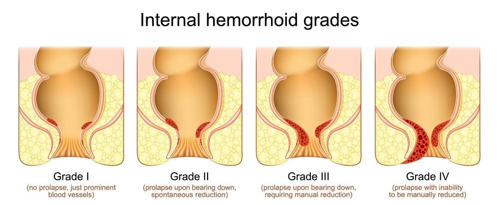 Hemorrhoids and treatments in dubai