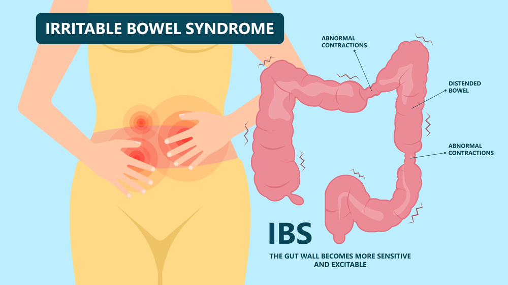 irritable bowel syndrome IBS