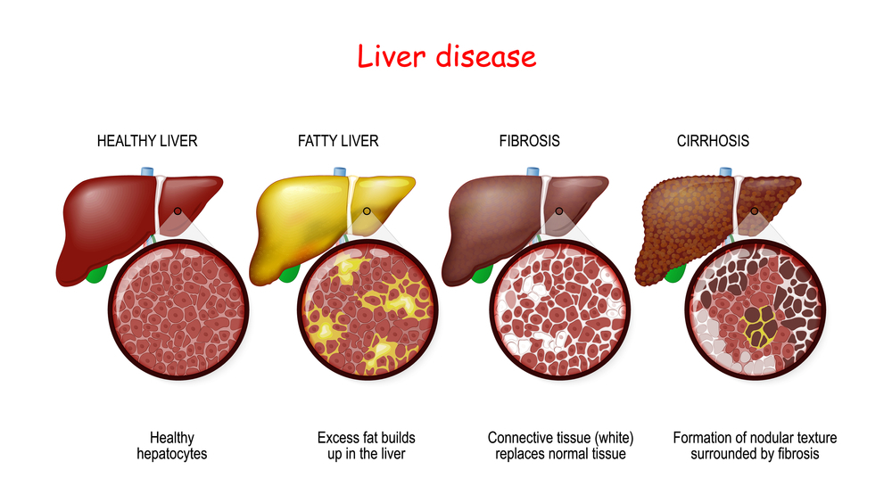 Liver diseases and treatments in dubai